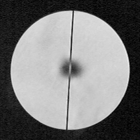 astigmatism -- spot at roc