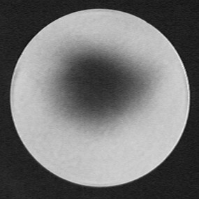 astigmatism -- spot at roc